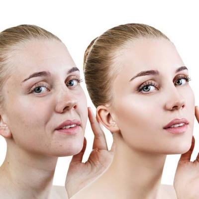 The Increase in Interest for Facelifts Due to Working from Home