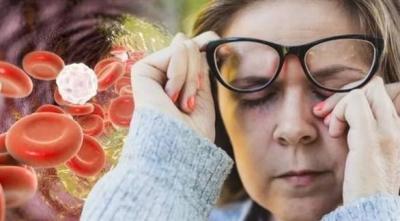 3 Indicators in Your Eyes of Dangerous Cholesterol Levels
