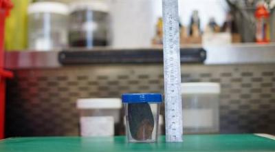 Extraction of One of the Largest Gallstones in the World from a Patient in Dubai