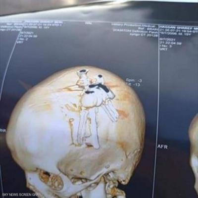 Investigation into "Child Crime" in Egypt: Key Inserted in Classmate's Head