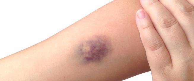 What Causes Blue Spots on the Body?