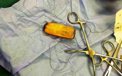 Man Keeps Mobile Phone in Stomach for Six Months