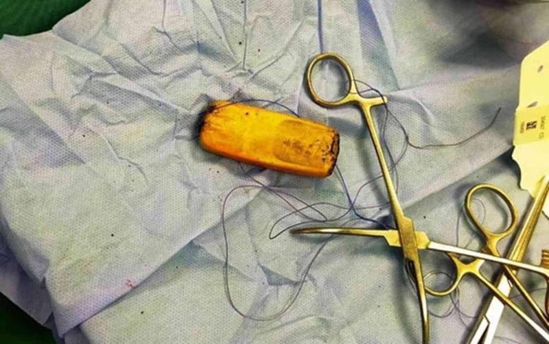 Man Keeps Mobile Phone in Stomach for Six Months
