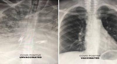 X-ray Images Show the Difference Between Lungs Before and After Vaccination