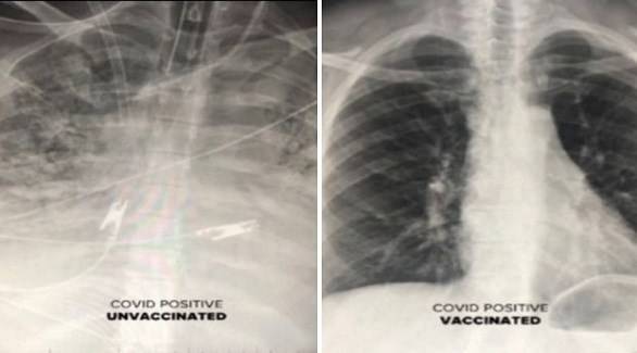 X-ray Images Show the Difference Between Lungs Before and After Vaccination