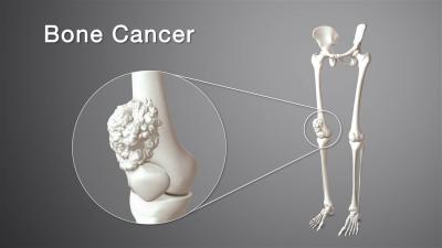 Unexplained Weight Loss... A Symptom of Bone Cancer