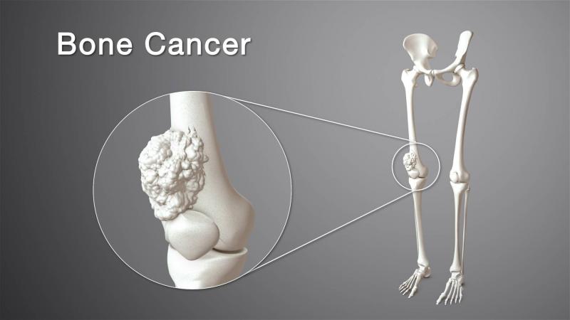 Unexplained Weight Loss... A Symptom of Bone Cancer