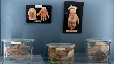Museum That Sparks Fear in Vienna: Skulls and Human Organs