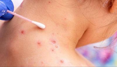 Title: Two Strains of "Monkeypox" and a Warning