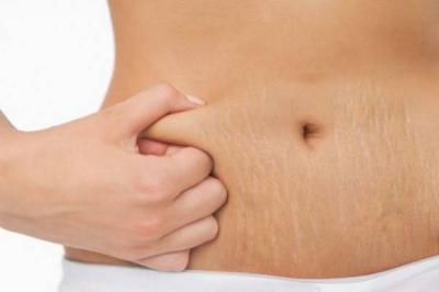 Getting Rid of Cellulite in Preparation for Summer