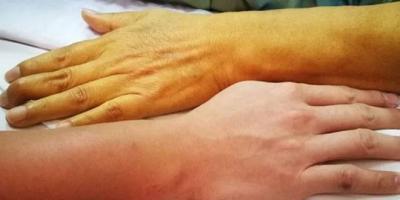"Jaundice" is Dangerous and Rapidly Spreading.. Call for a Health Emergency!