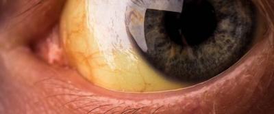 Causes of Yellowing of the Eyes