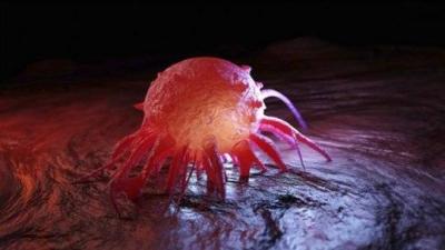 Subcutaneous Lump May Indicate "Rare" Tumor