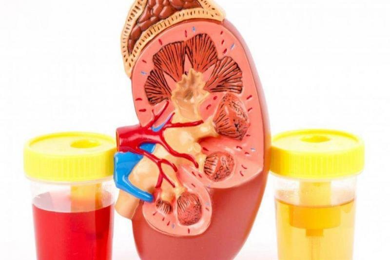 Main Causes of Blood in Urine