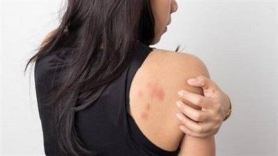 Signs of Stress and Tension Appearing on the Skin