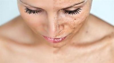 Caring for Your Skin: How to Get Rid of Pigmented Spots