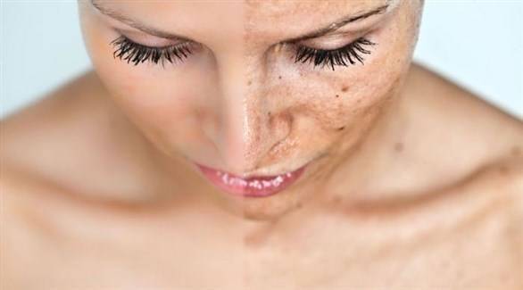 Caring for Your Skin: How to Get Rid of Pigmented Spots