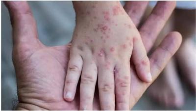 Foods to Prevent Monkeypox and Strengthen Immunity: Here are 6 Foods!
