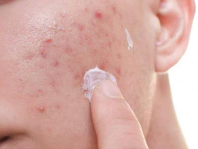 # How to Easily Get Rid of Acne Scars