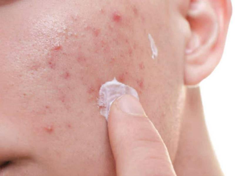 # How to Easily Get Rid of Acne Scars