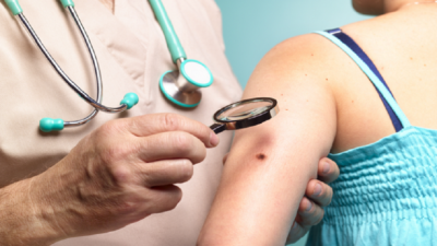Signs of Moles Turning into Skin Cancer