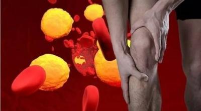 Early Indicator of High Cholesterol in the Legs
