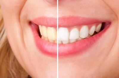 Methods for Whiter Teeth Overnight