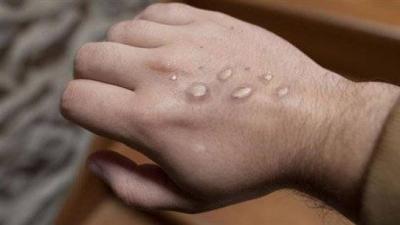 New Information About "Monkeypox": Does it Leave Marks on the Skin?
