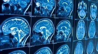 Promising Discovery Opens the Door to Alzheimer’s Treatment