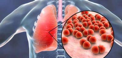 Organization: Hundreds of Thousands Will Die from Tuberculosis Due to COVID-19