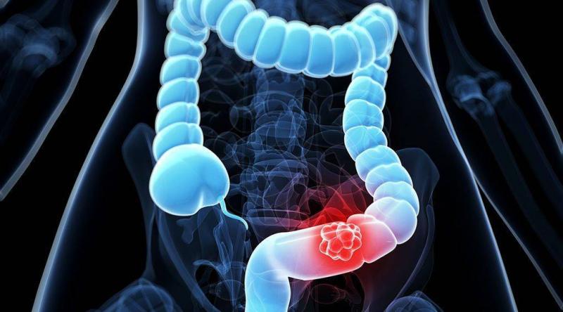 The Easiest Way to Reduce Your Risk of Colon Cancer