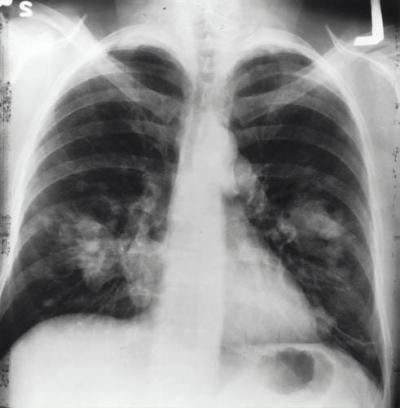 5 Sudden Symptoms Indicating Lung Cancer