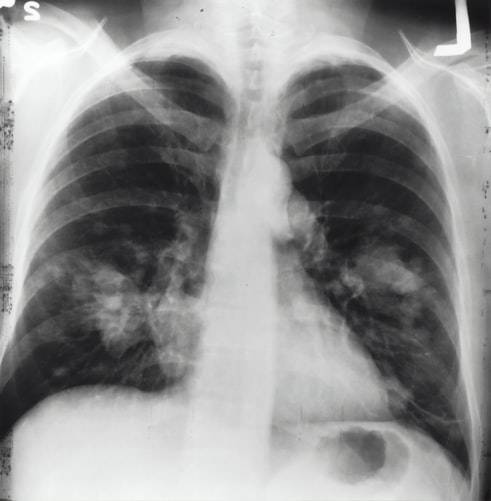 5 Sudden Symptoms Indicating Lung Cancer