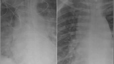 The Difference Between the Lungs of COVID-19 Patients: One Vaccinated and One Not