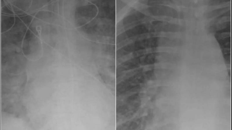 The Difference Between the Lungs of COVID-19 Patients: One Vaccinated and One Not