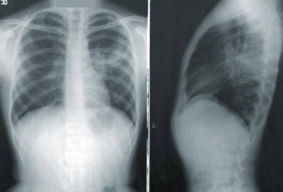 Indicators in Your Voice for Lung Cancer