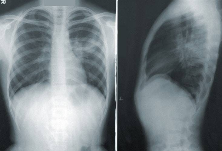 Indicators in Your Voice for Lung Cancer