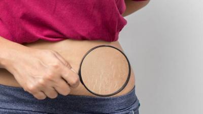 Three Home Remedies to Help Get Rid of Stretch Marks on the Body