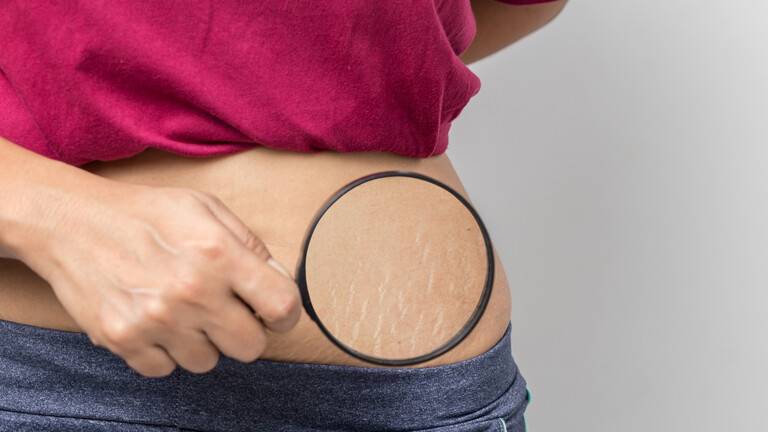 Three Home Remedies to Help Get Rid of Stretch Marks on the Body