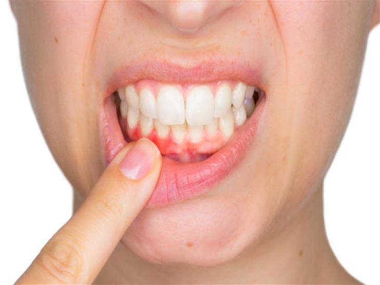 Gum Bleeding May Reveal a Vitamin C Deficiency