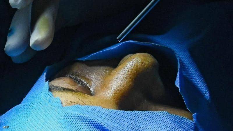 Black Fungus in Iraq: Announcement of a Death in Kirkuk