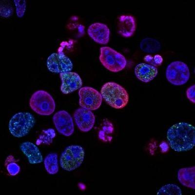 4 Foods That Increase Cancer Cell Growth