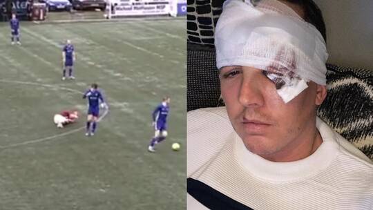 Video: Player Brutally Headbutts Opponent, Nearly Costing Him His Eye