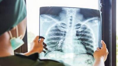 "Shocking" Images Reveal Lung Damage in Unvaccinated COVID-19 Patients