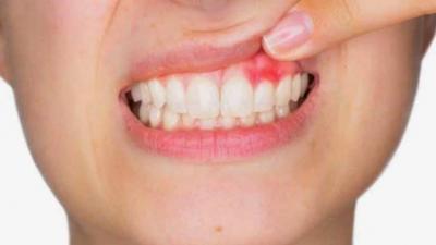 Title: Gum Disease Linked to Higher COVID-19 Death Rate
