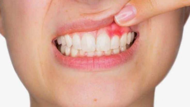 Title: Gum Disease Linked to Higher COVID-19 Death Rate