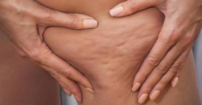 Home Remedies for Treating Cellulite