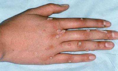 "Monkeypox" Expands in Europe and Reaches Canada