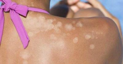 Causes of Ringworm (Tinea) and Home Remedies for This Skin Infection