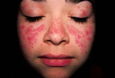Natural Treatment for Lupus